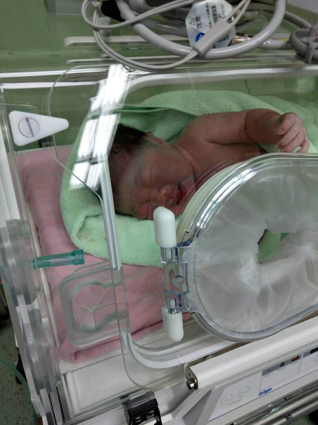 Elpis剛出生就鎖骨骨折 寶寶真的不是越大越好 自然產4075克寶寶後續 新生兒鎖骨骨折 艾煮日子